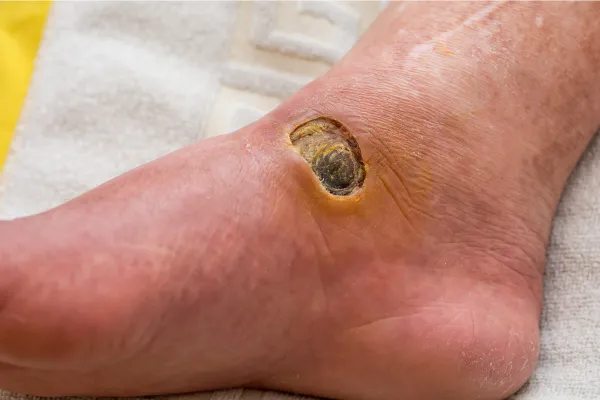 ಮಧುಮೇಹದ ಗಾಯಗಳು (Diabetic Wound) - RJR Herbal Hospitals Treatment ಮಧುಮೇಹದ ಗಾಯಗಳು (Diabetic Wound) - ಗಿಡಮೂಲಿಕೆ ಚಿಕಿತ್ಸೆ