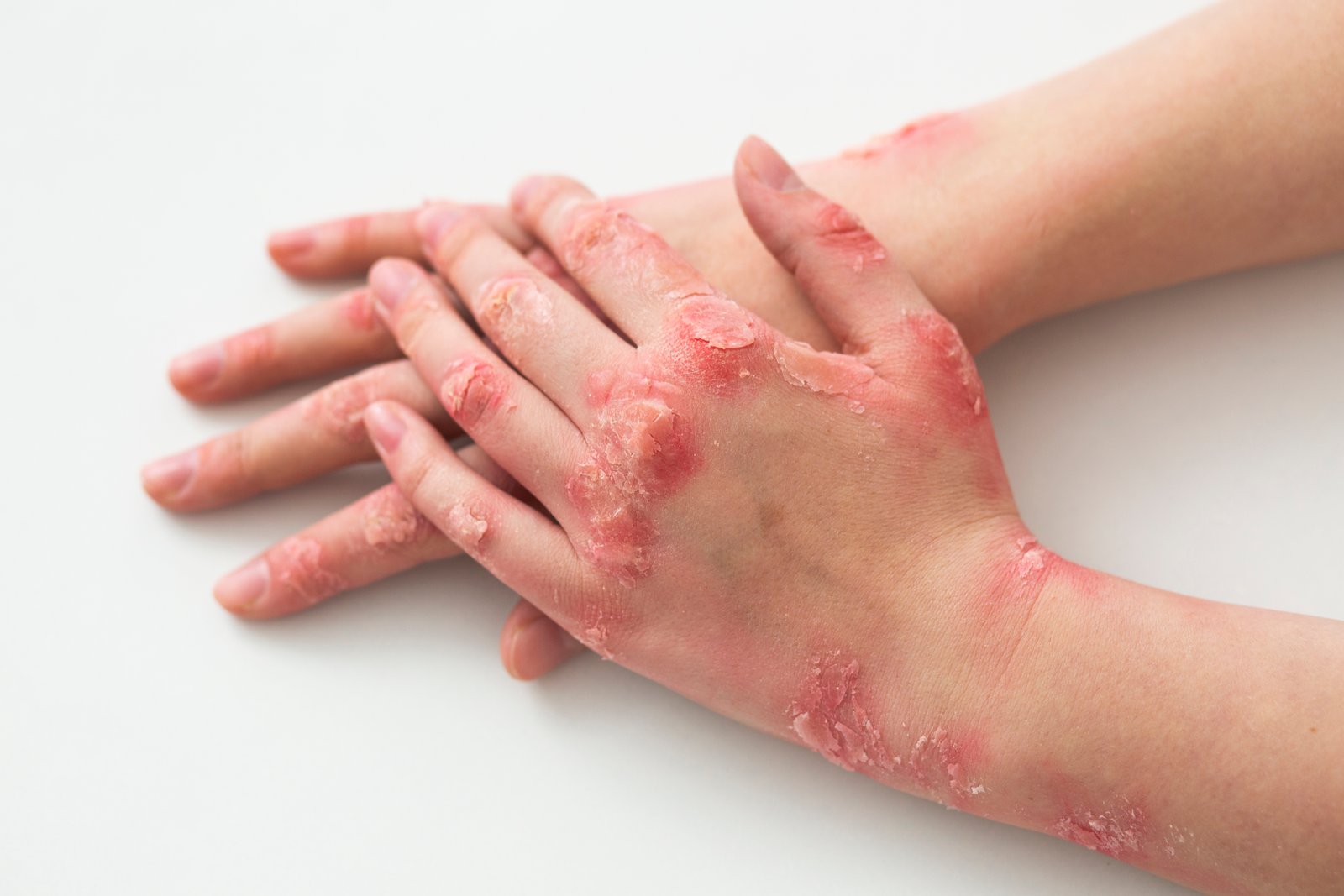 ಶಿಲೀಂಧ್ರ ಸೋಂಕು (Fungal Infection) - RJR Herbal Hospitals Treatment ಶಿಲೀಂಧ್ರ ಸೋಂಕು (Fungal Infection) - ಗಿಡಮೂಲಿಕೆ ಚಿಕಿತ್ಸೆ