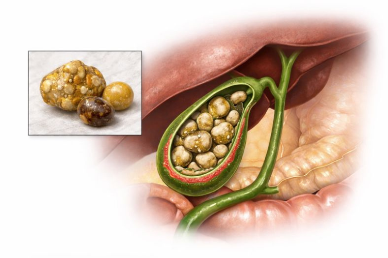 ಪಿತ್ತಕೋಶದ ಕಲ್ಲುಗಳು (Gall Bladder Stones) - RJR Herbal Hospitals Treatment ಪಿತ್ತಕೋಶದ ಕಲ್ಲುಗಳು (Gall Bladder Stones) - ಗಿಡಮೂಲಿಕೆ ಚಿಕಿತ್ಸೆ