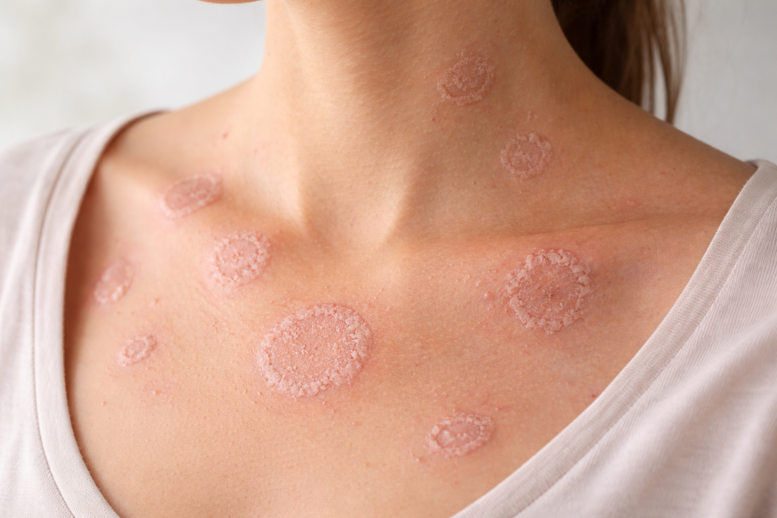 ಇತರ ಚರ್ಮ ಸಮಸ್ಯೆಗಳು (Other Skin Diseases) - RJR Herbal Hospitals Treatment ಇತರ ಚರ್ಮ ಸಮಸ್ಯೆಗಳು (Other Skin Diseases) - ಗಿಡಮೂಲಿಕೆ ಚಿಕಿತ್ಸೆ