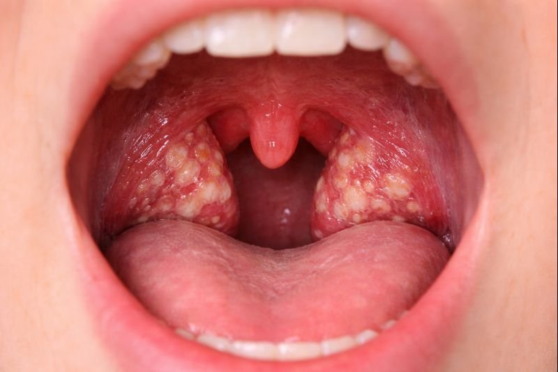 ಗಂಟಲು ಬೇನೆ / ಗಂಟಲು ಗ್ರಂಥಿಯ ಊತ (Tonsillitis) - RJR Herbal Hospitals Treatment ಗಂಟಲು ಬೇನೆ / ಗಂಟಲು ಗ್ರಂಥಿಯ ಊತ (Tonsillitis) - ಗಿಡಮೂಲಿಕೆ ಚಿಕಿತ್ಸೆ